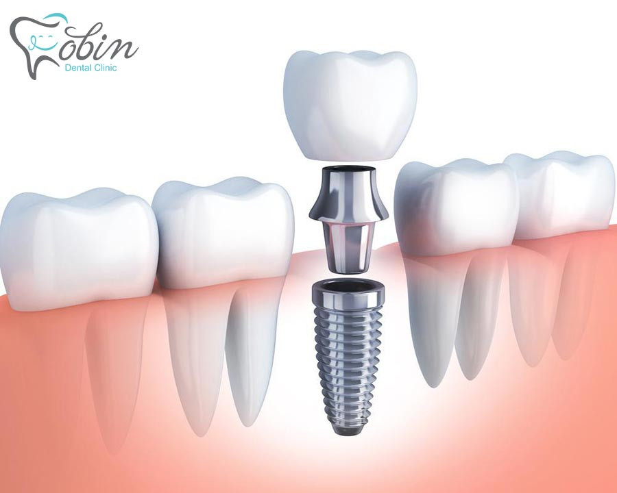 هر ایمپلنت دندان از بدنه، اباتمنت و روکش تشکیل شده است.